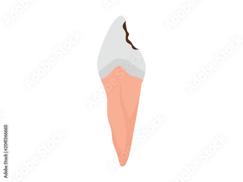Human Tooth Decay Cavity Illustration
