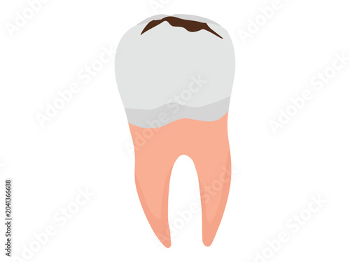 Human Tooth Decay Cavity Illustration
