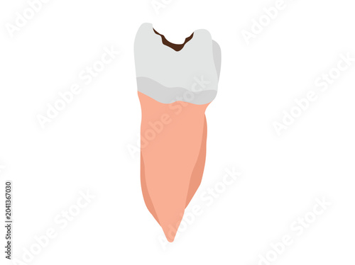 Human Tooth Decay Cavity Illustration
