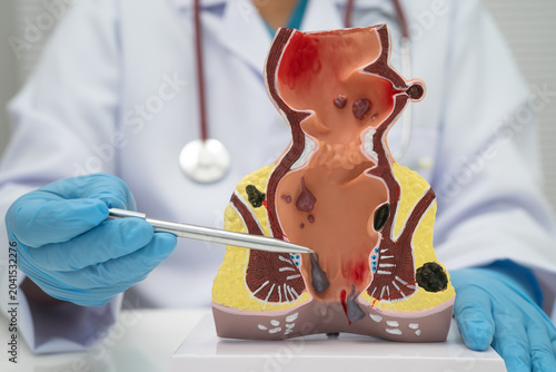 Fényképezés Asian doctor with rectum and hemorrhoid human model, inflamed vascular structure
