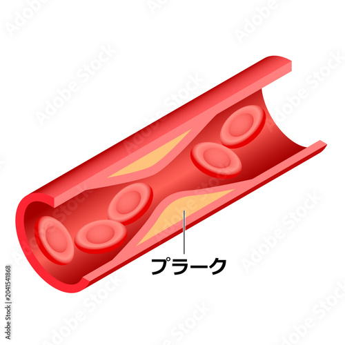 頸動脈プラーク