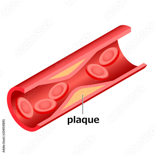 Carotid artery plaque