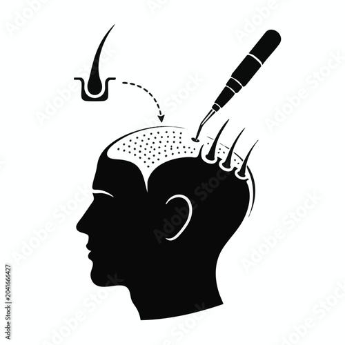 Hair transplantation, hair restoration, balding treatment, hair loss solution, vector icon