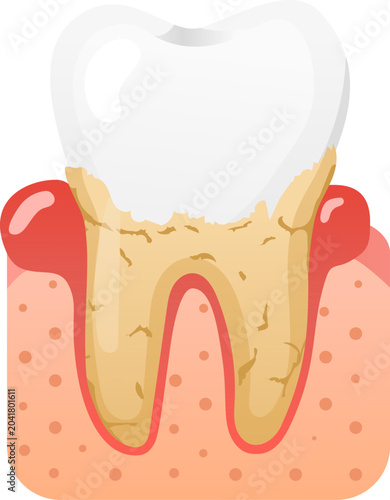 Fotografija Tooth plaque tartar gum decay cavity dental dentistry hygiene disease cartoon to