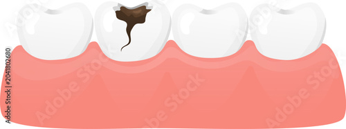 Foto Tooth decay dental cavity rotten tooth dental caries tooth damage tooth pain gum