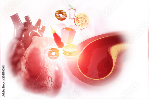 3D medical illustration of a human coronary artery severely clogged with yellow fatty cholesterol plaque.