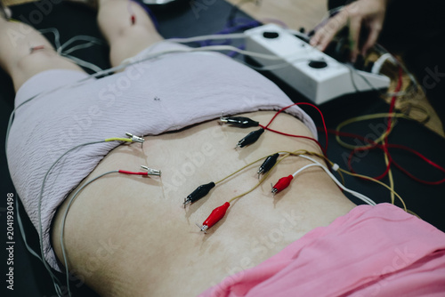 Electroacupuncture therapy on a woman, needles stimulated by a machine for relaxation and wellness.
