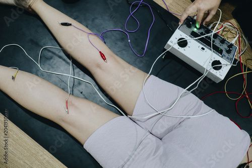 Obraz na płótnie Electroacupuncture therapy on a woman, needles stimulated by a machine for relaxation and wellness