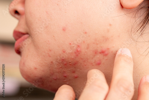 Bild auf Leinwand Close up of woman cheek with problematic skin conditions including acne, pimples, red spots and blemishes