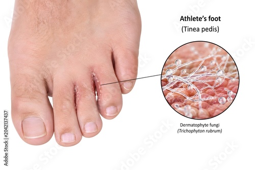 Realistic Medical Diagram of Athlete’s Foot with Dermatophyte Infection on Human Skin