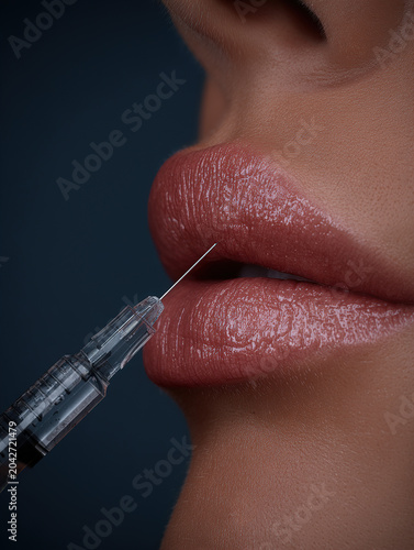 Close-Up Lip Filler Injection Procedure On Natural Full Lips For Cosmetic Beauty And Aesthetics