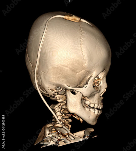 Slika na platnu 3D CT Scan of Pediatric Skull with Ventriculoperitoneal Shunt