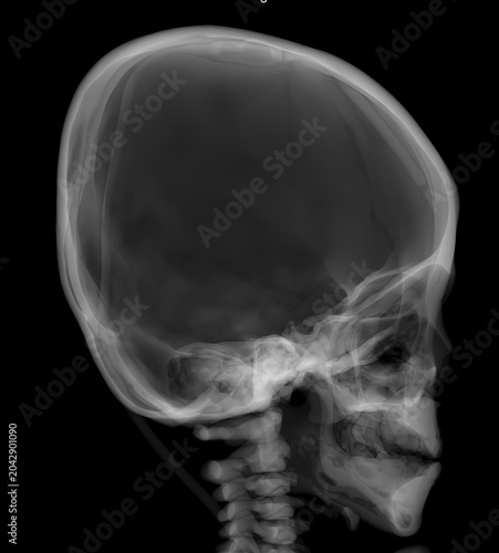 Tableau sur toile 3D CT Scan of Pediatric Skull with Ventriculoperitoneal Shunt