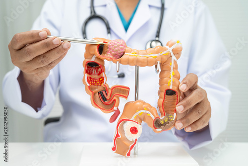 Fotografie Colorectal cancer, doctor holding intestine colon human anatomy model