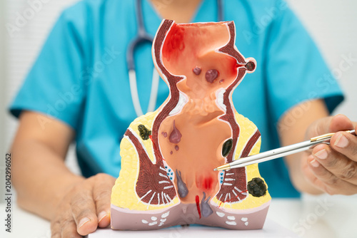 Fotografia Asian doctor with rectum and hemorrhoid human anatomy model at hospital, inflamed vascular structure
