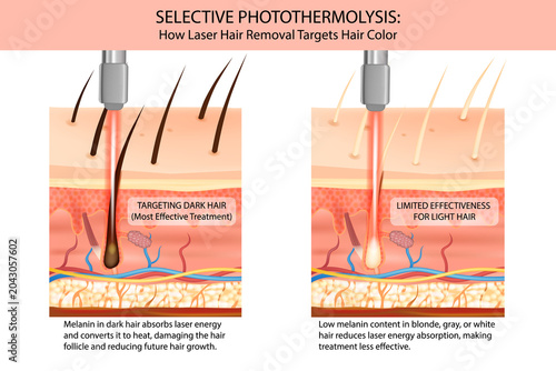Selective Photothermolysis in Laser Hair Removal Treatment Showing Effective Targeting of Dark Hair and Reduced Effectiveness for Light Hair. Laser Hair Removal Mechanism Demonstrating Melanin Absorpt