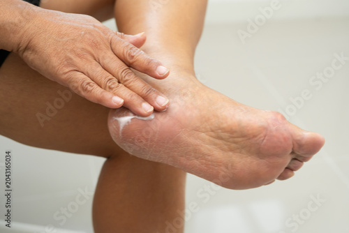 Asian woman check feet with crack and dry heel skin, Diabetic Foot.