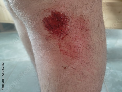 Fotografie blessure genou sang croûte jambe