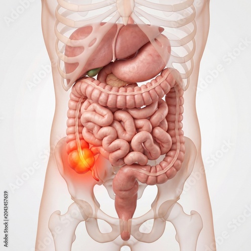 Anatomical illustration of human digestive system with glowing red appendicitis pain in the lower right abdomen area on a clean white background