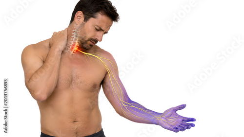 Cervical Spine Radiculopathy Nerve Pathway Medical Illustration for Arm Numbness Patient Education