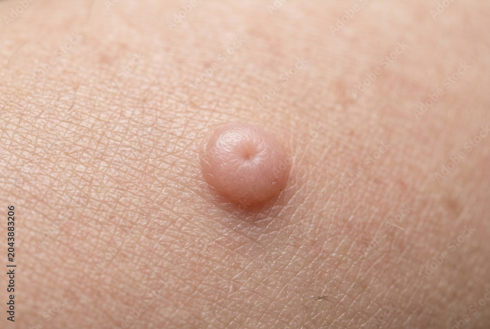 Fototapeta premium Close up of raised pink skin mole or bump on human skin