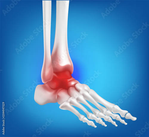 vector anatomical illustration human foot ankle skeleton ankle joint tarsal bones indicates significant pain, sprains, arthritis, gout,