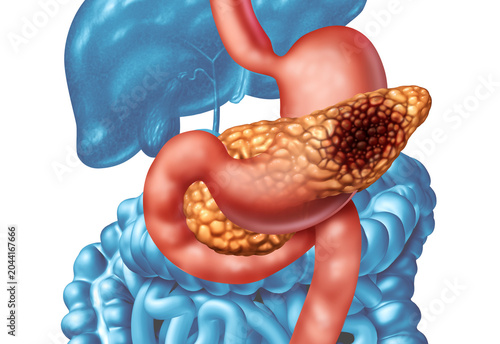 Bild auf Leinwand Pancreatic cancer concept as a malignant tumor in the pancreas within the digest