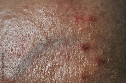 Close-up texture of the human skin with pimples and acne