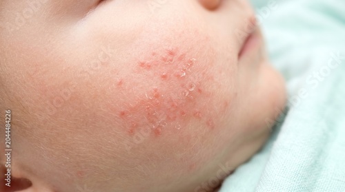 Infantile eczema papules and dry patches on cheek of a newborn