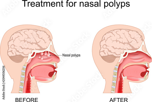 Nasal polyps treatment. Nasal sinus anatomy before and after endoscopic sinus surgery or steroid therapy. Cross-section of human nasal cavity