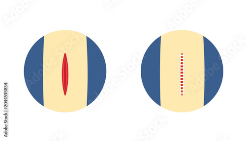 Fotografie Surgical stitches and wound icon flat vector illustration