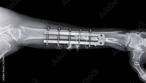 Ultra-realistic film x-ray showing arm fracture repaired with plate, screws, and internal fixation, clean clinical view, detailed bone contours, premium realism