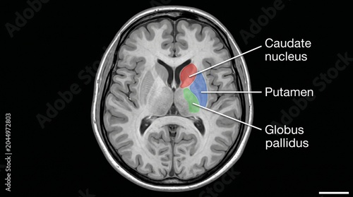 Labeled diagram of brain showing caudate nucleus putamen globus