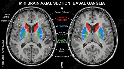 Mri brain axial section showing basal ganglia with color-coded regions