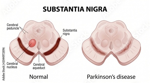 Substantia nigra in normal brain and parkinson's disease brain