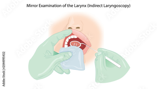Bild auf Leinwand Mirror Examination of the Larynx (Indirect Laryngoscopy) demonstrating indirect laryngoscopy using a laryngeal mirror to visualize the vocal cords and laryngeal structures