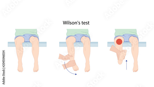 Fotografija Wilson’s Test for Developmental Dysplasia of the Hip Wilson’s test used to assess hip pathology and evaluate pain during rotational movement of the lower limb