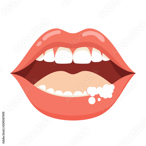 Illustration of a mouth with a cold sore on the lip