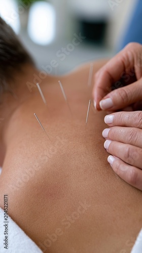 Close up acupuncture treatment with sterile needles on bare upper back for wellness clinic therapy background and healthcare treatment imagery