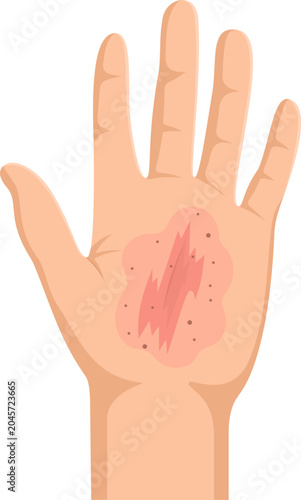 Illustration of Skin Rash on Hand