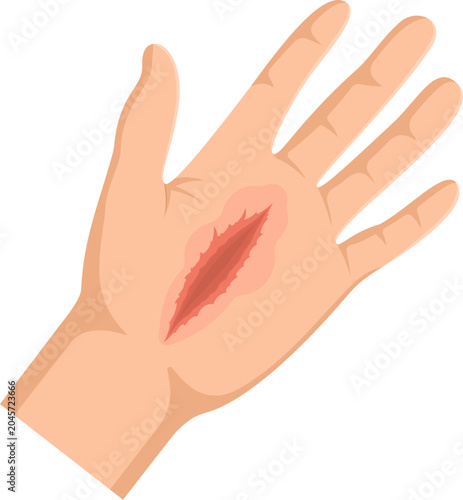 Illustration of a Cut on a Human Hand