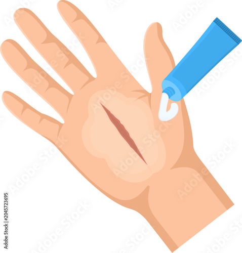 Applying Ointment To Hand Wound
