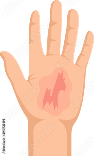 Illustration of Skin Rash on Hand