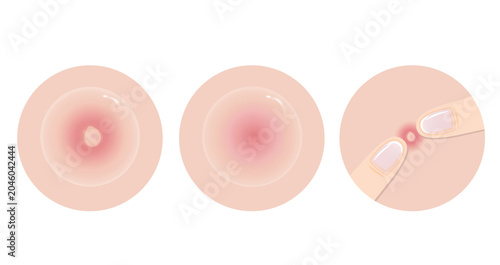 Obraz na plátně The way to get rid of acne pimple vector icon set illustration on white background