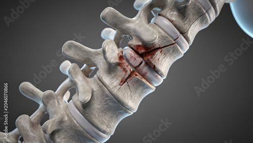 Ultra-realistic 3d medical illustration of spine fracture, separated vertebrae, detailed intervertebral discs, dark neutral background, precise medical realism