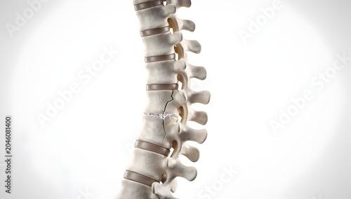 Ultra-realistic medical 3d spine render showing fractured vertebrae, high-detail bone structure, soft light, white background, authentic diagnostic anatomy image