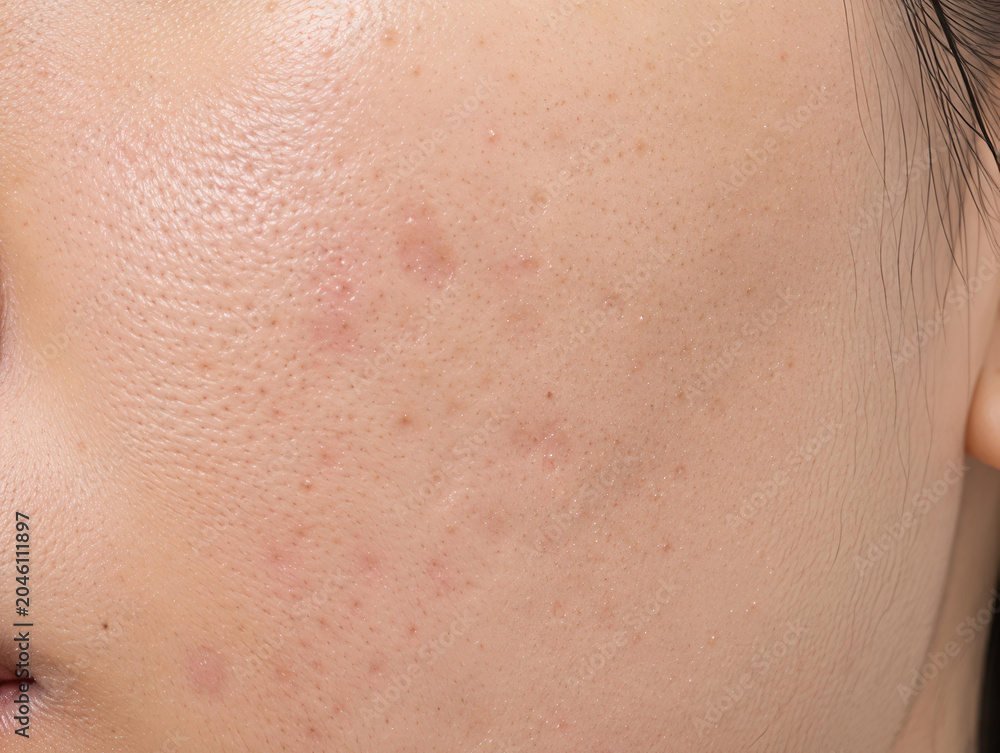 Fototapeta premium Close up of facial skin with acne, dark spots, freckles, and hyperpigmentation
