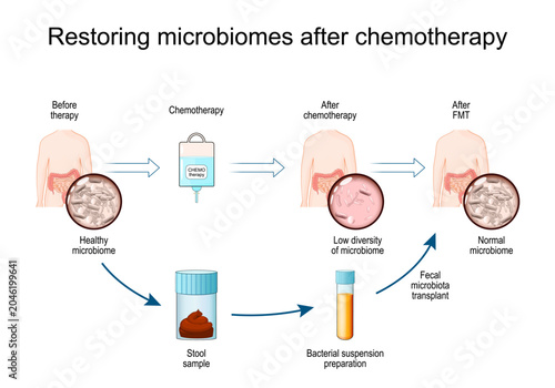Restoring microbiomes after chemotherapy. Human body and gut microbiota Before and After chemotherapy and FMT therapy.