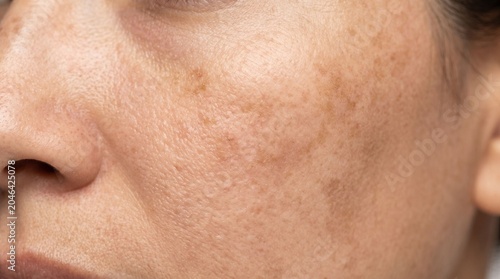 Close up of woman cheek with skin hyperpigmentation and brown spots 