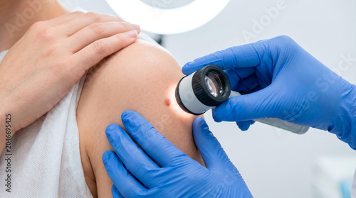 Dermatologist examines a mole on a patient's shoulder using a dermatoscope